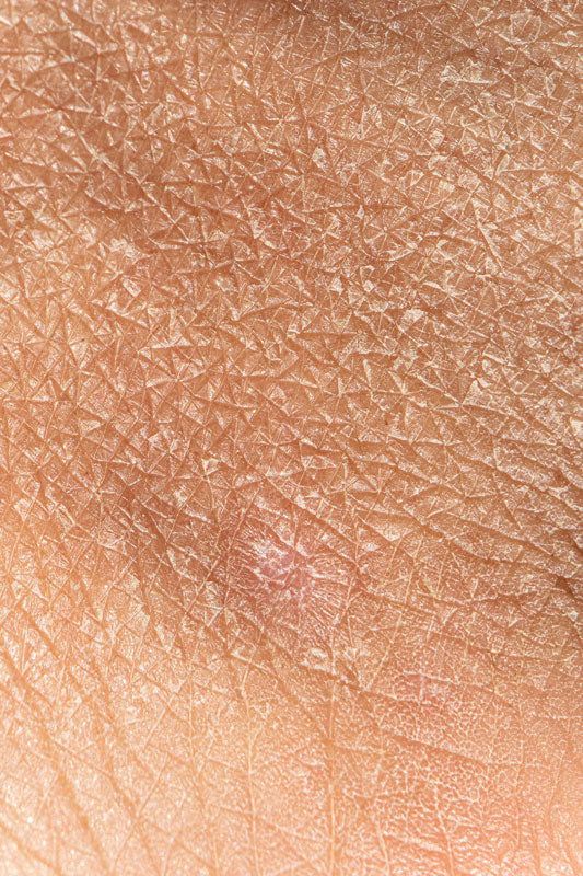 Dry skin