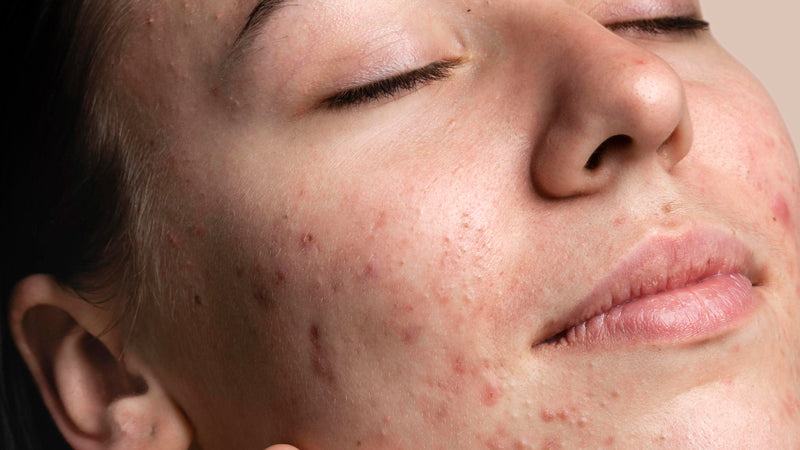 What is fungal acne